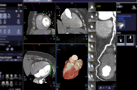 CTA 冠状动脉 3D 渲染图像在屏幕上用于诊断血管冠状动脉狭窄。
