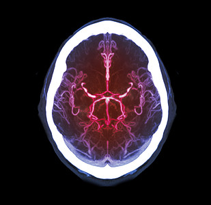 脑卒中摄影照片_CTA 大脑或 CT 血管造影的大脑比较 Mip 技术的轴向视图检测脑 anueurym 的集合。