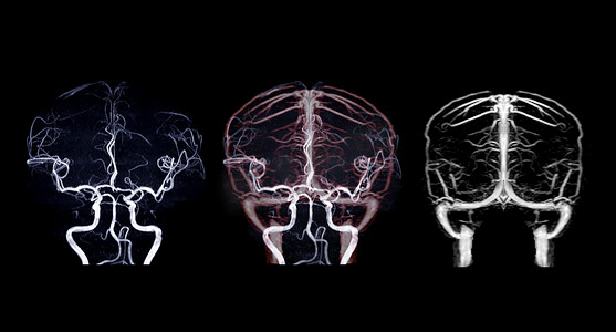 MRA 大脑和 MRV 大脑。