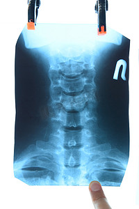 颈椎摄影照片_颈椎 X 光检查。