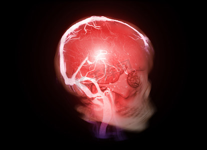 动脉瘤摄影照片_头骨 3D 与 CTV 大脑显示硬脑膜静脉窦，用于诊断静脉窦血栓形成