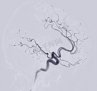 脑血管造影 介入放射学透视透视图像显示脑动脉。