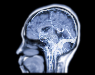 MRV 大脑或大脑磁共振静脉造影检查大脑矢状面静脉引流异常。