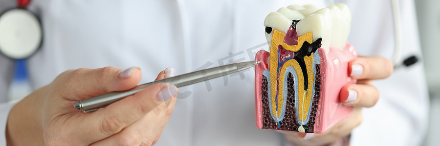 人造海摄影照片_医生用圆珠笔在塑料人造牙模型特写上显示龋齿腔