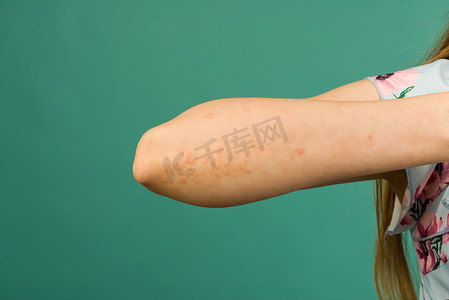 特写：面目全非的年轻女性患有自身免疫性无法治愈的皮肤病，称为牛皮癣。