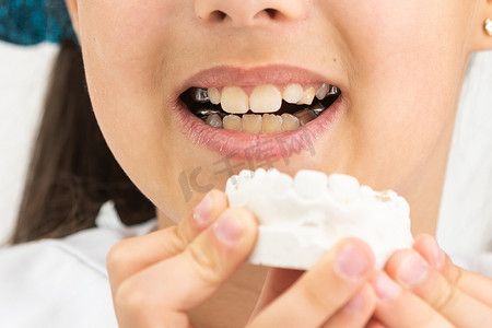 在牙齿矫正治疗开始时，青少年在治疗完成后拿着一个牙齿模型和她的牙齿。