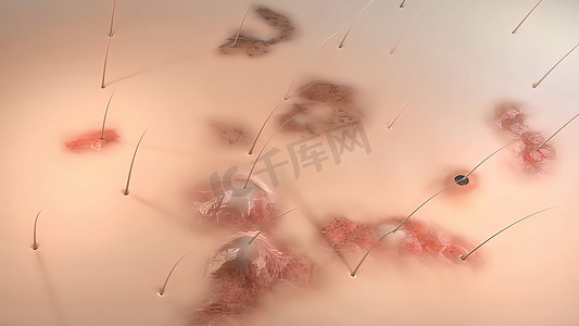 痤疮或粉刺的形成。堵塞毛孔中的皮脂会促进某些细菌的生长