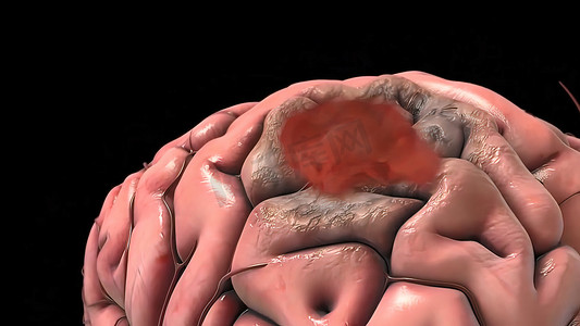 脑动脉瘤是大脑血管的隆起或膨胀。