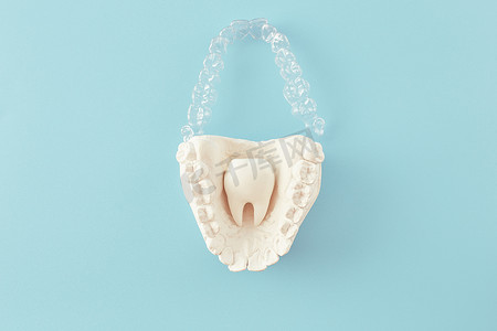 蓝色背景中的正畸牙科主题。适用于正畸牙科治疗的透明隐形牙齿矫正器或牙套