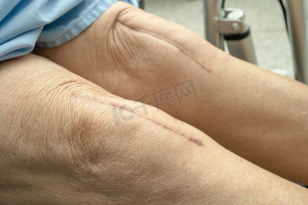 亚洲老年或老年老太太妇女病人在护理医院病房的床上展示她的疤痕手术全膝关节置换缝合伤口手术关节成形术，健康强大的医疗理念。