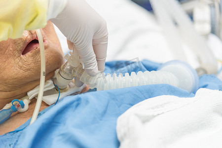 病人在医院做气管切开术和呼吸机
