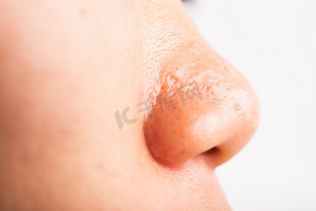 女人毛孔粗大有雀斑脸颊油腻，鼻子上有痤疮粉刺