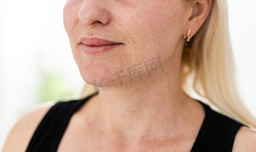 女人丘疹脸，女人的皮肤纹理。