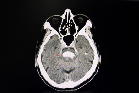 中风 CT 布赖恩