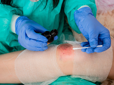一位女医生在诊所用碘治疗一名十几岁女孩膝盖上的伤口，特写。