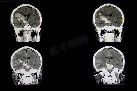 急性出血性中风患者布赖恩的 CT 扫描