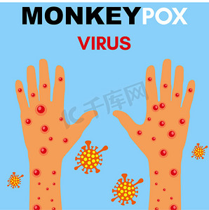 猴痘病毒插图，猴痘手载体，猴痘病毒爆发流行病设计与微观背景