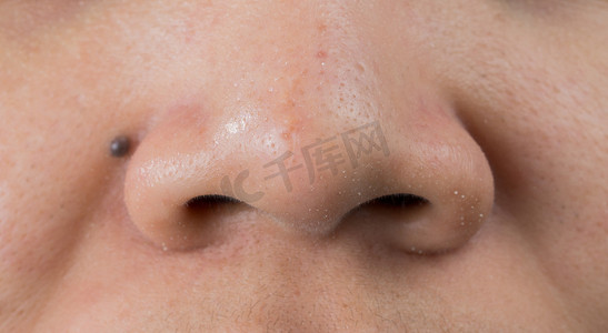 亚洲女性鼻子上的黑头痤疮。