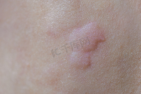 皮肤上出现荨麻疹。
