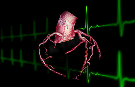CTA 冠状动脉 3D 渲染图像在屏幕上用于诊断血管冠状动脉狭窄。