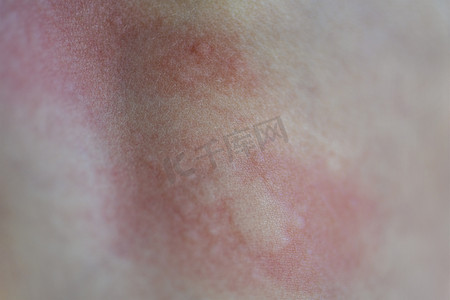 皮肤斑点摄影照片_皮肤上出现荨麻疹。