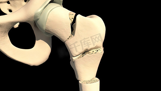 人类的脚摄影照片_股骨骨折是大腿骨的断裂、裂纹或挤压伤。
