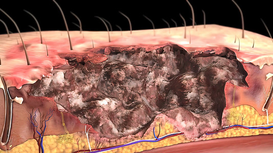 人体皮肤严重烧伤