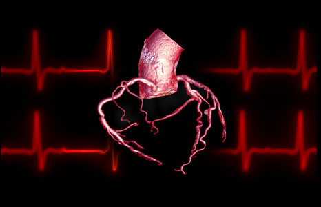 动脉瘤摄影照片_CTA 冠状动脉 3D 渲染图像在屏幕上用于诊断血管冠状动脉狭窄。
