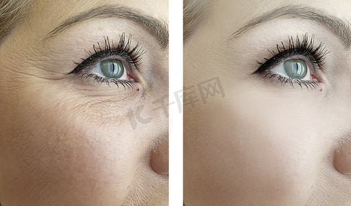 手术前后女性眼睛皱纹