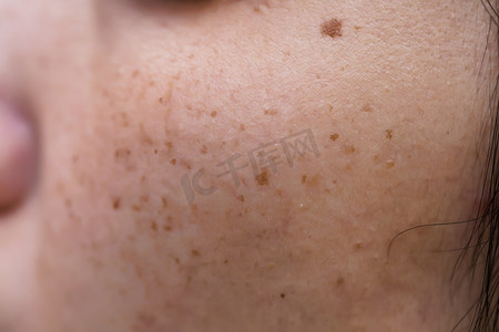 女人有问题的皮肤，痤疮疤痕，油腻的皮肤和毛孔，黑斑和脸上的黑头和白发