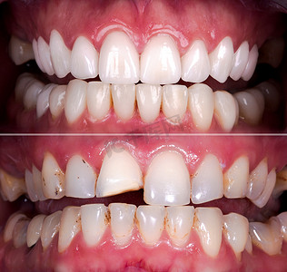 氧化锆拱形陶瓷假体植入冠冕前、后的完美笑容。牙科康复治疗诊所的病人。口腔外科手术美白牙的结果