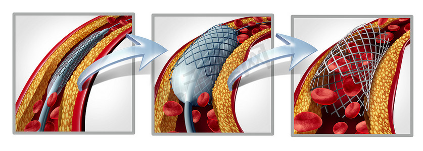 冠状动脉支架和血管成形术的概念作为心脏病治疗符号图与植入程序的阶段在动脉中, 有胆固醇斑块堵塞被打开, 以增加血液流量为3d 例证.
