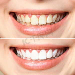 美白前后的妇女牙齿。白色的背景。牙科诊所的病人图为口腔护理、牙科、口腔科的象征