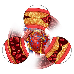 疾病摄影照片_心脏动脉疾病和冠心病的医学概念，即逐渐形成斑块，导致动脉阻塞和动脉粥样硬化，是具有三维示踪元素的人体解剖学.