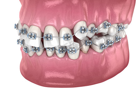 牙齿位置不正常,用金属矫形器矫正错误.医学上准确的牙科3D图像