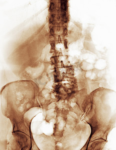 伴有退行性关节炎改变的脊柱光片