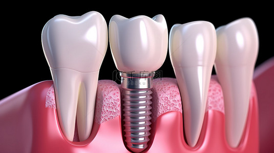 牙科牙医背景图片_医学上精确的牙种植体治疗过程图解