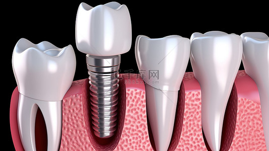 牙种植体治疗过程的医学精确 3D 插图