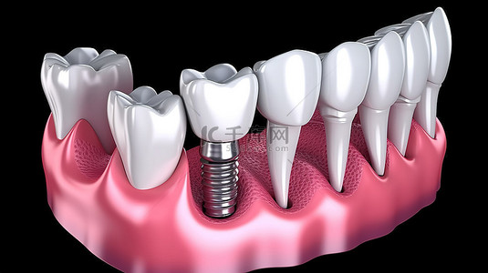 口腔背景图片_种植牙过程的准确 3D 插图