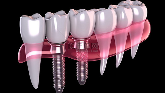 牙种植过程医学上精确的义齿治疗 3D 渲染