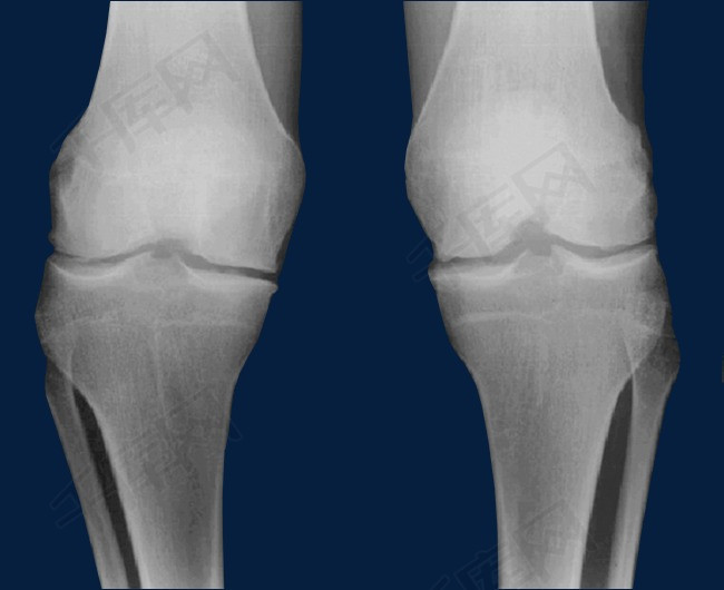 膝关节x光x光膝关节人体骨骼医疗骨关节