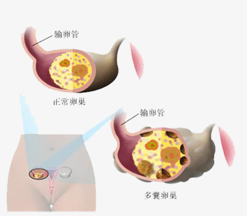 卵巢高清图