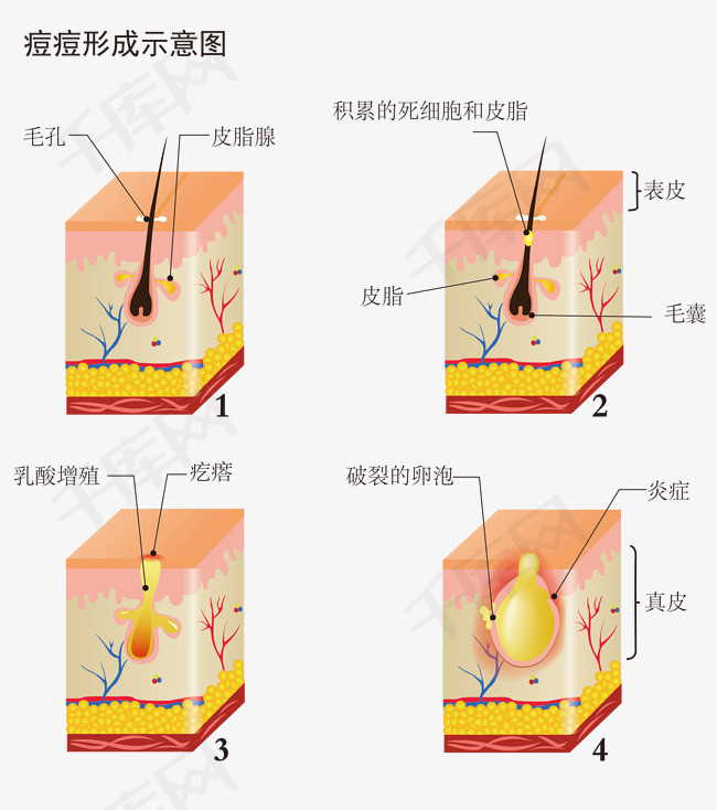 脸部痘痘形成示意图