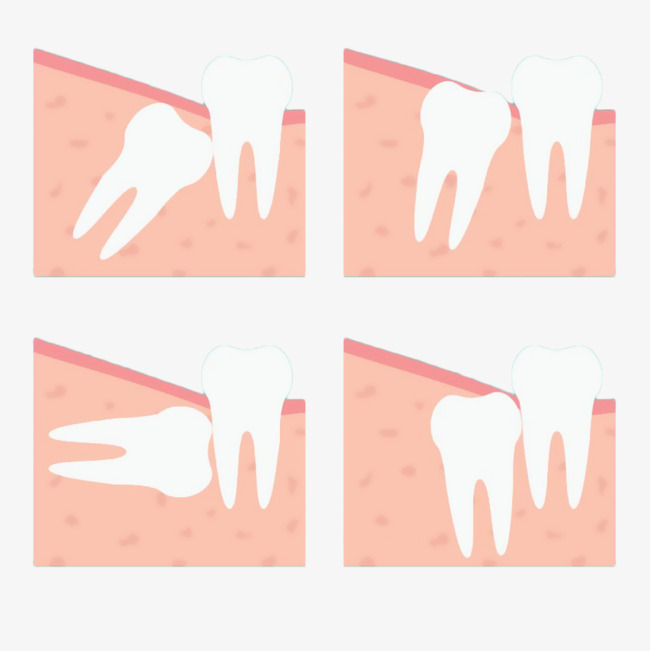 卡通牙科智齿生长方向配图插画免抠卡通牙齿智齿口腔牙龈肿痛