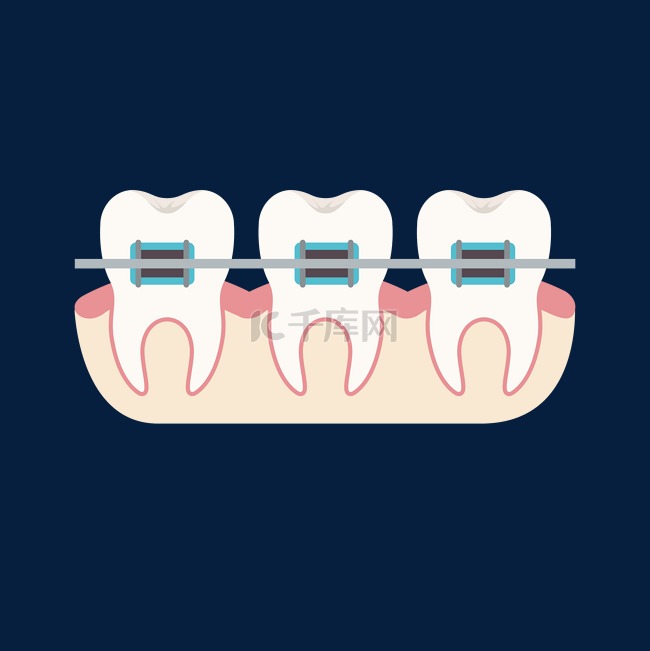 箍牙剖面示意图矢量素材