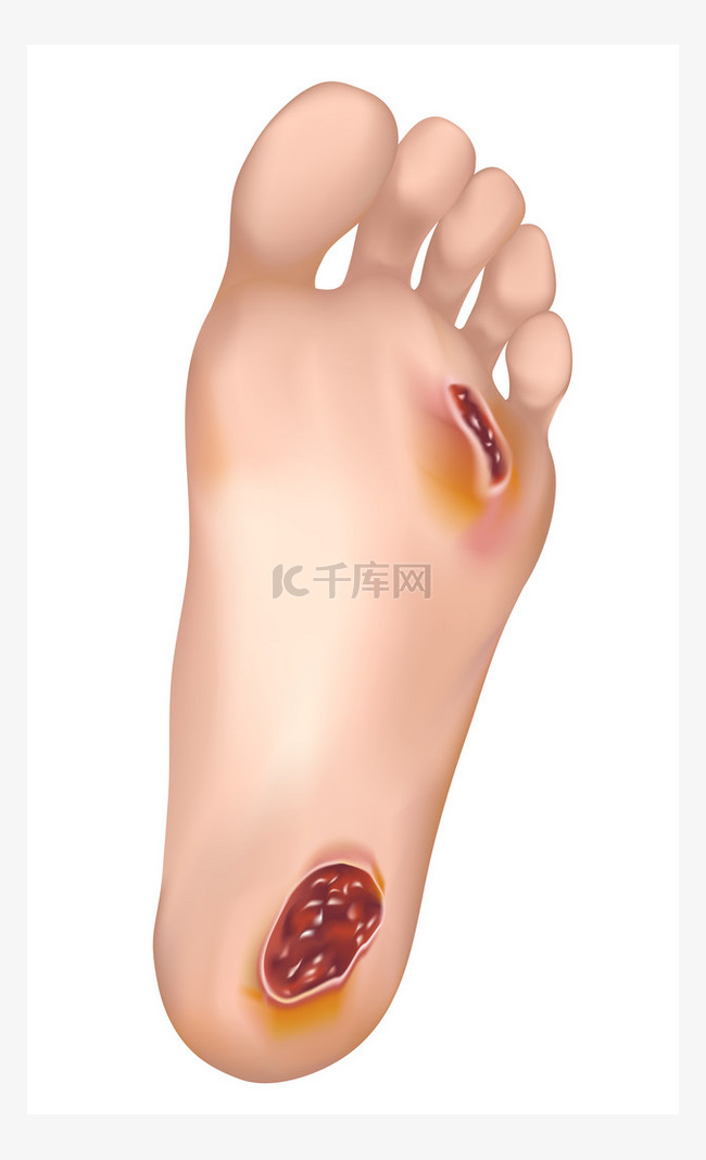 Diabetic foot.