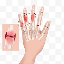 肿痛图片_手指关节炎发炎肿痛