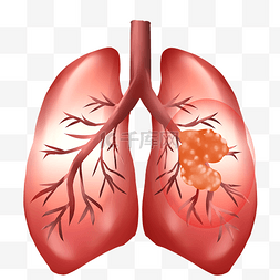 肺部吸氧图片_肺器官恶性肿瘤