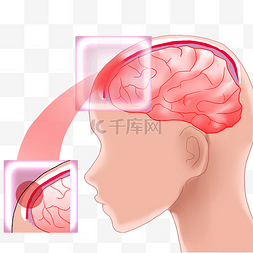 脑医疗图片_医疗医学脑膜炎病症