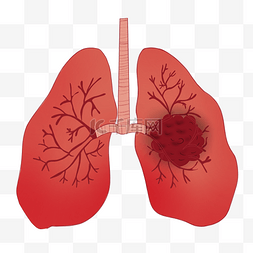 肺癌肺部疾病